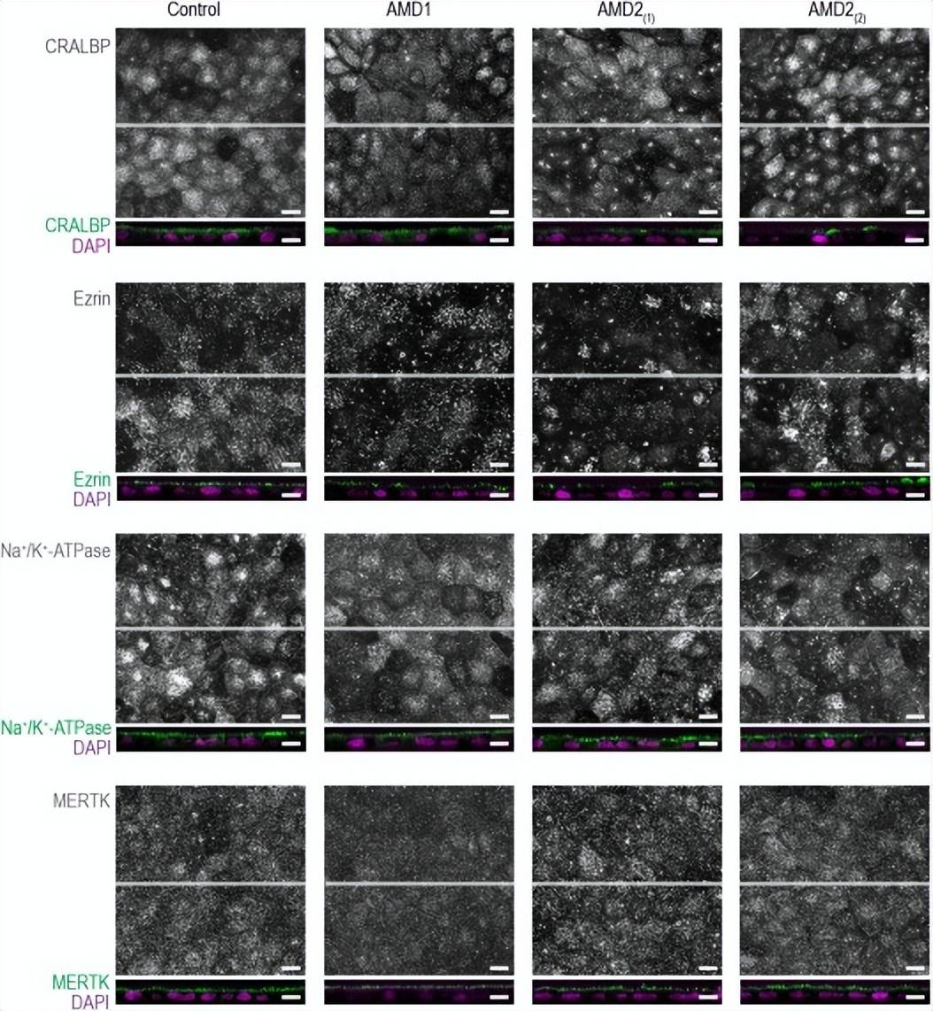 视网膜色素变性最新疗法,希望之光为视界带来新生