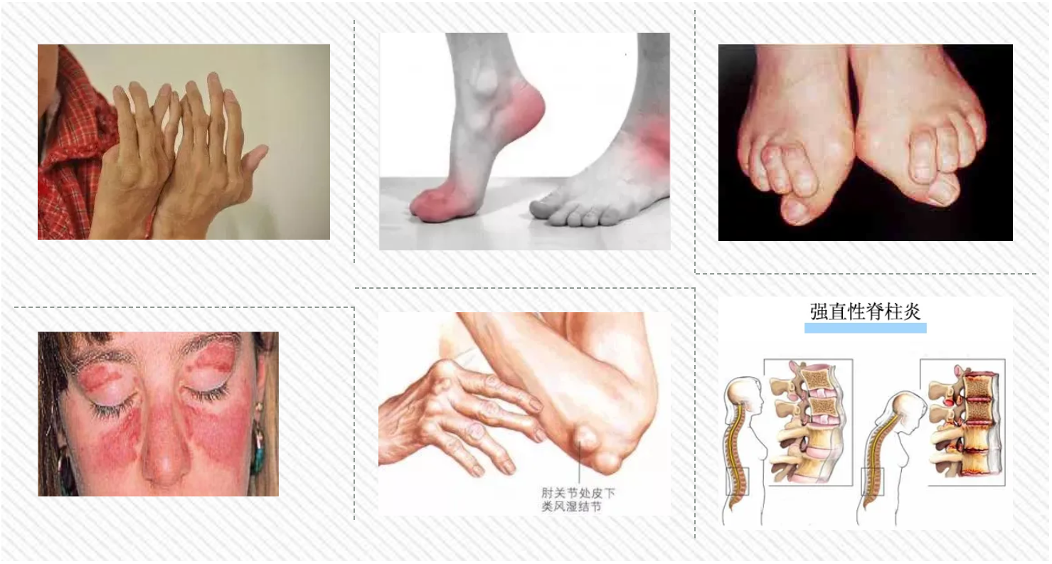 风湿领域最新进展与研究动态