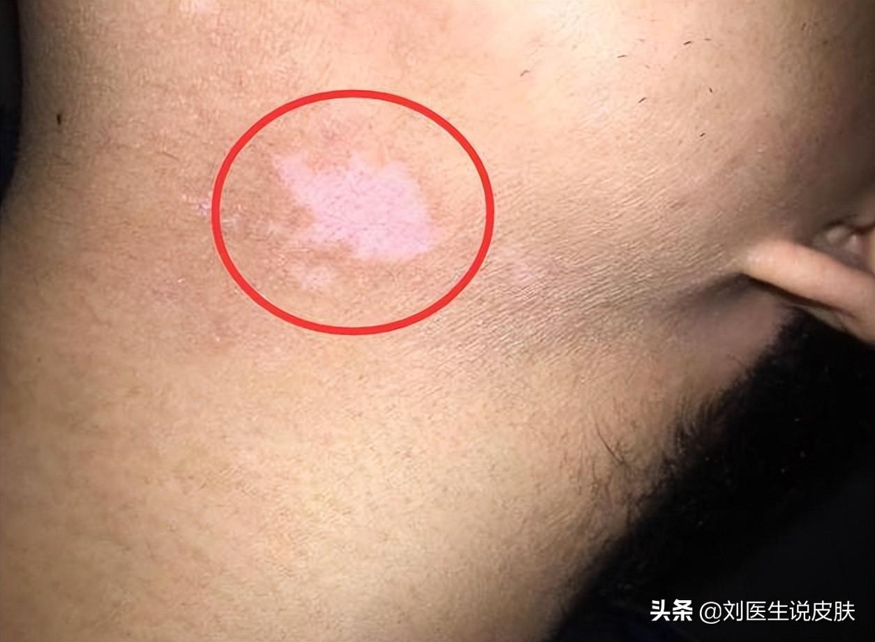 白癜风最新治疗方法揭秘,最新白癜风治疗策略大解密