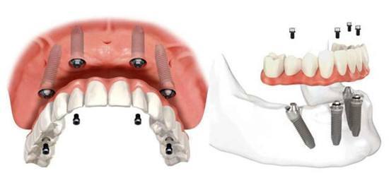 全面解读,种牙植牙价格与费用结构指南