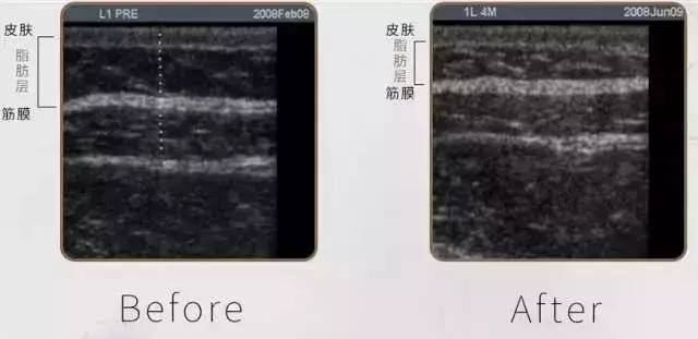 最新溶脂技术重塑美丽未来