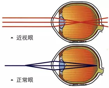 近视眼治疗最新方法揭秘,最新科技助力视力恢复之路